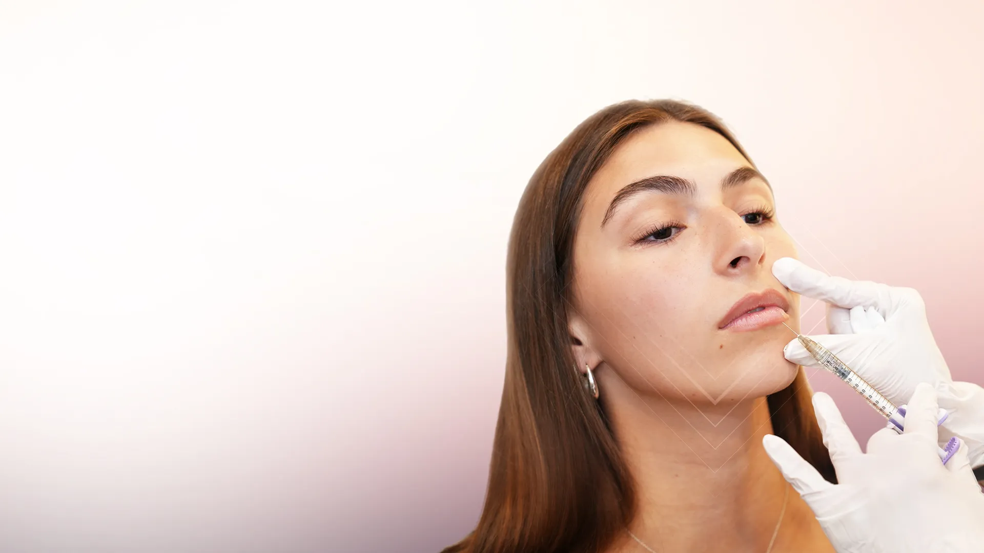 Hyaluronic Acid Lip Fillers for Soft, Balanced Lips treatment at Toronto medical spa - Subtle Enhancement That Keeps You Looking Like You...
